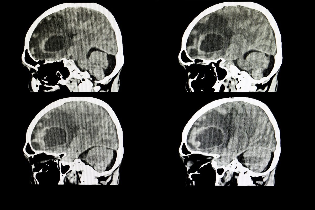 Scanner cerebral de una paciente con tumor
